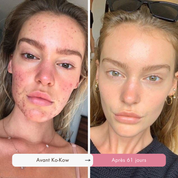 Routine Définitive Anti-Imperfections & Acné