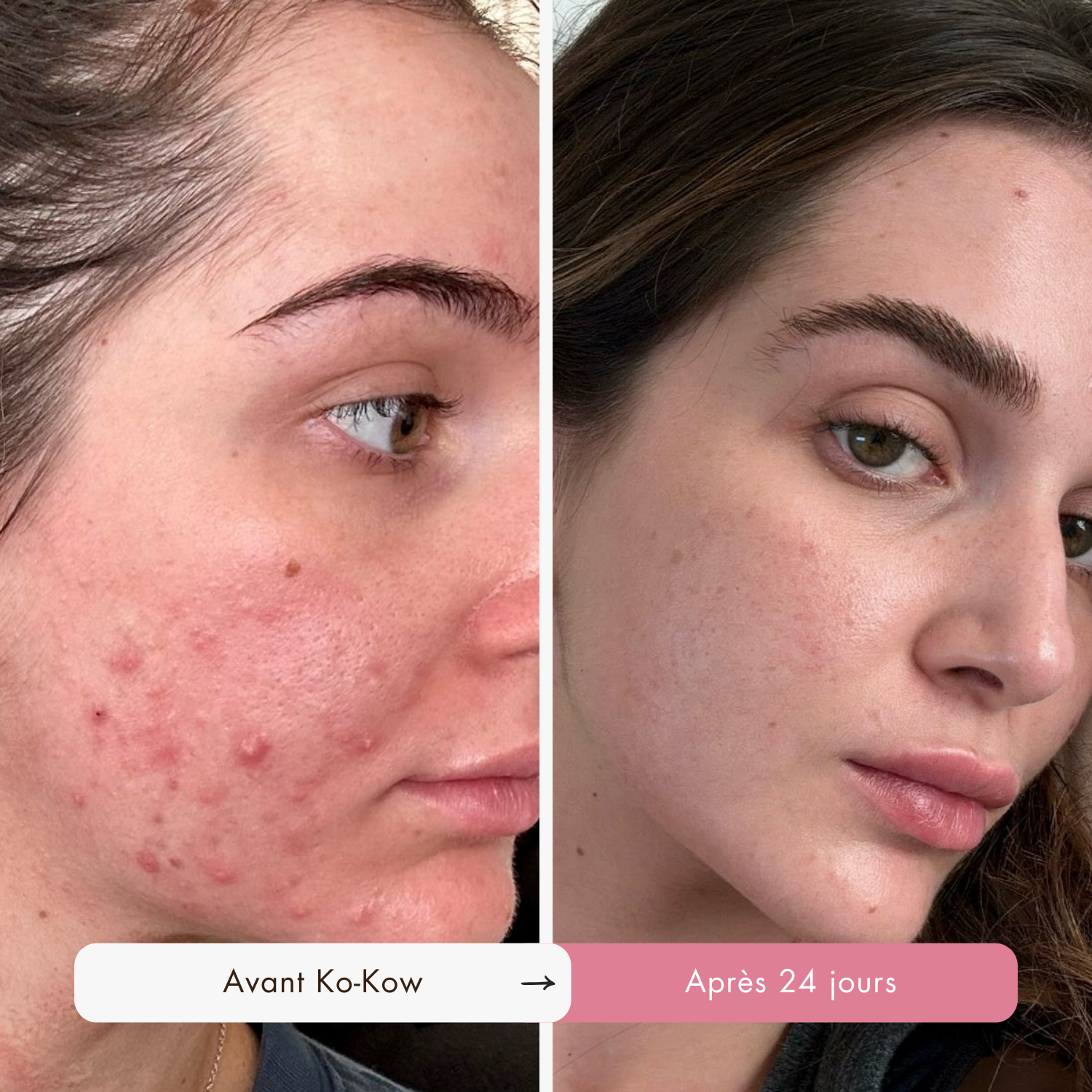 Routine Définitive Anti-Imperfections & Acné