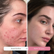 Routine Définitive Anti-Imperfections & Acné