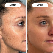 Pack Solution Instantanée Anti-Points Noirs & Peaux Mortes