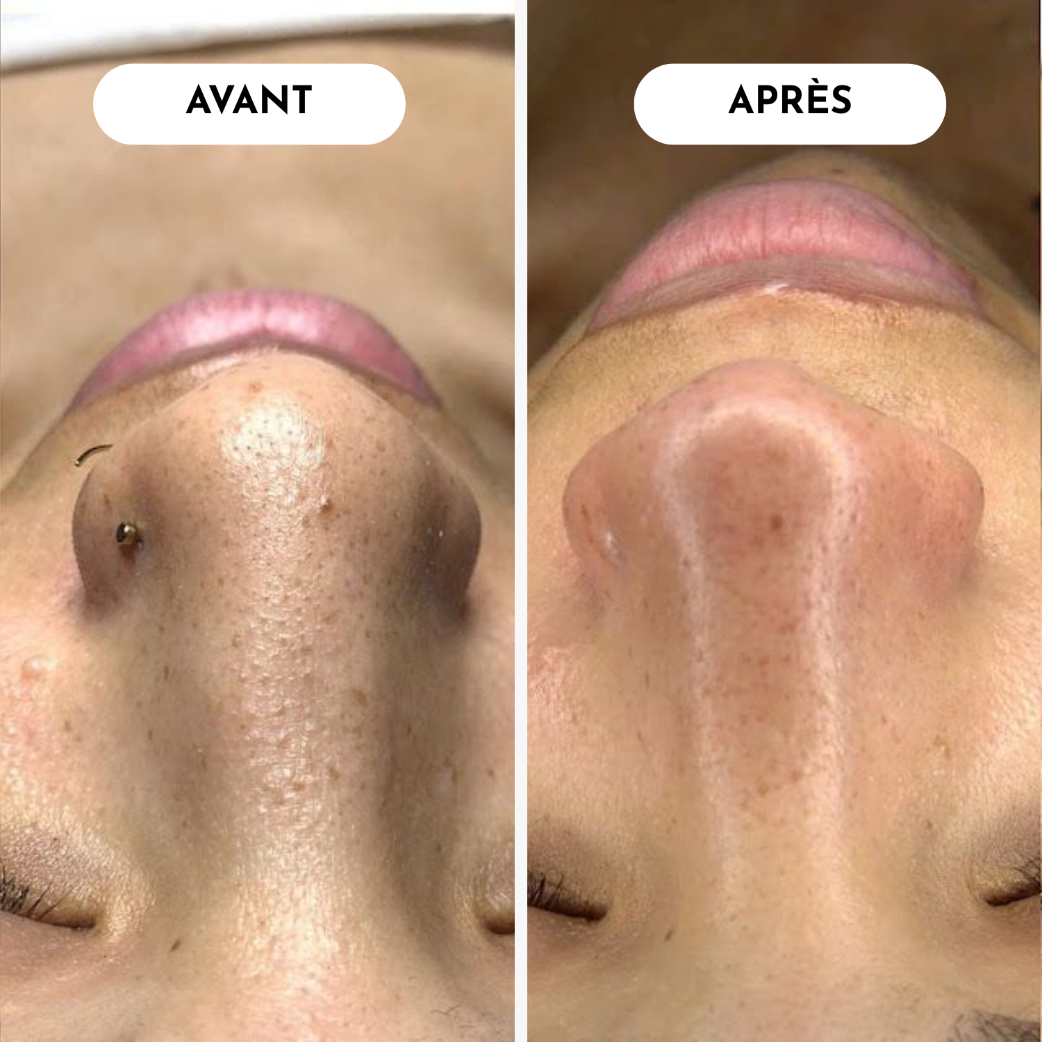 Pack Solution Instantanée Anti-Points Noirs & Peaux Mortes